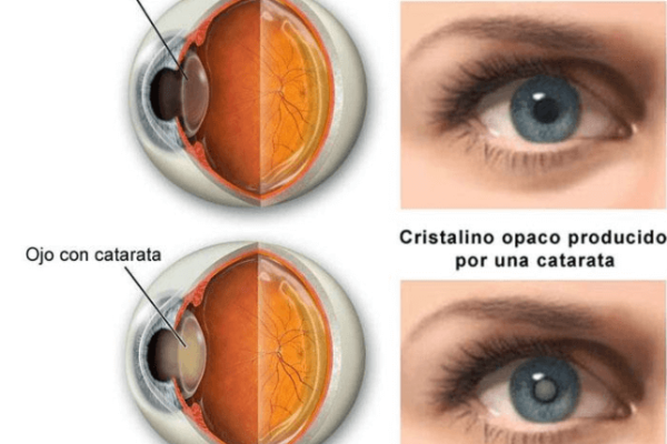 catarata vs ojo normal