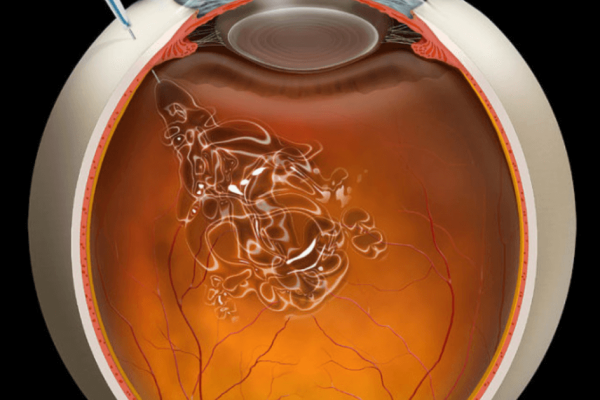 inyeccion-intravitrea-ocular