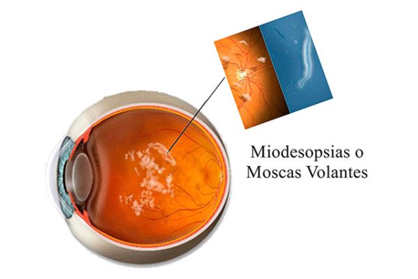 miodesopsias-o-moscas-volantes